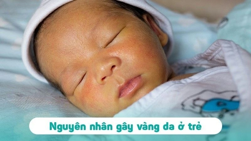 Nguyên nhân khiến trẻ bị vàng da thường gặp