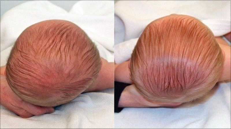 Nguyên nhân khiến trẻ bị méo đầu do nằm nhiều
