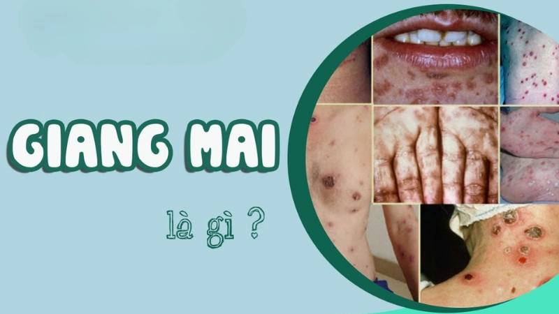 Giang mai là gì? Những thông tin cần biết để bảo vệ sức khỏe