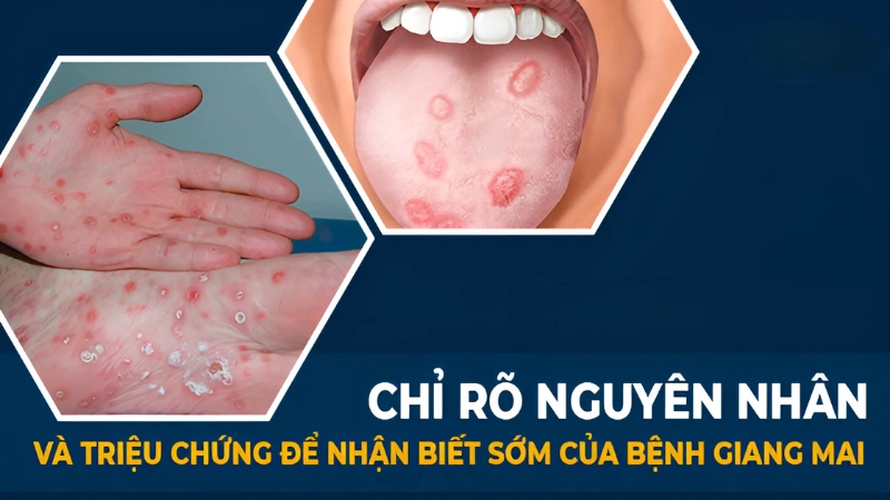 Triệu chứng của bệnh giang mai qua từng giai đoạn