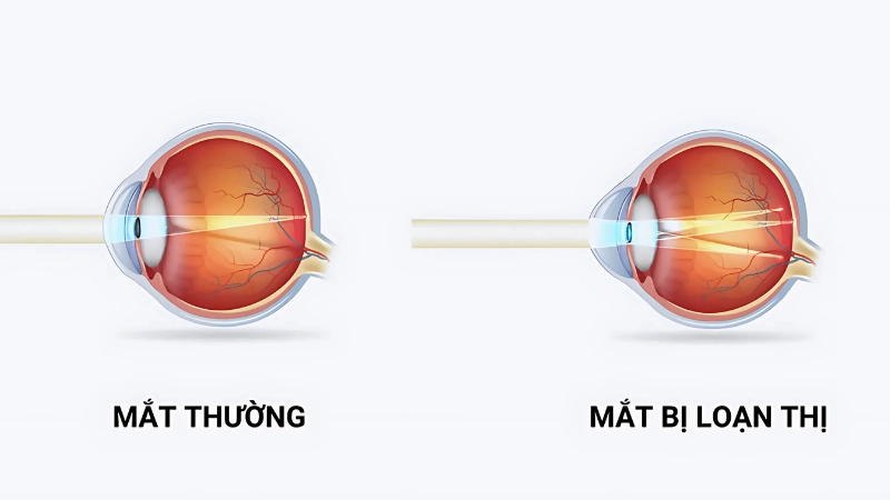 Các dạng loạn thị thường gặp cận loạn, viễn loạn, loạn thị bẩm sinh