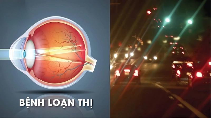 Cách điều trị và phòng ngừa loạn thị hiệu quả