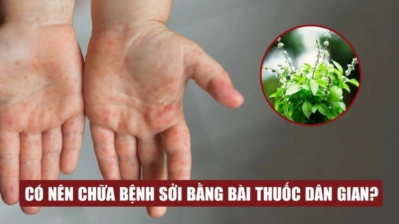 Cách áp dụng mẹo dân gian chữa sởi an toàn tại nhà