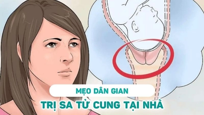 Bài thuốc dân gian trị sa tử cung được lưu truyền rộng rãi