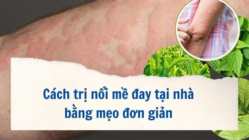 Hết ngứa hết sưng nhờ mẹo dân gian chữa mề đay tại nhà