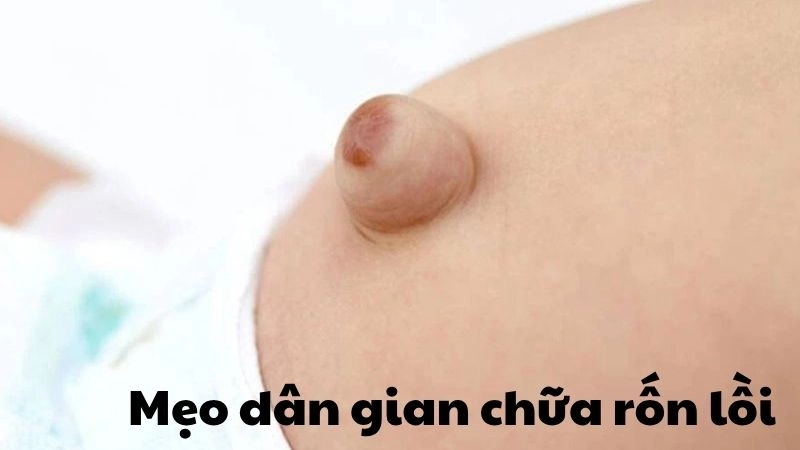 Cách áp dụng mẹo dân gian chữa rốn lồi hiệu quả tại nhà