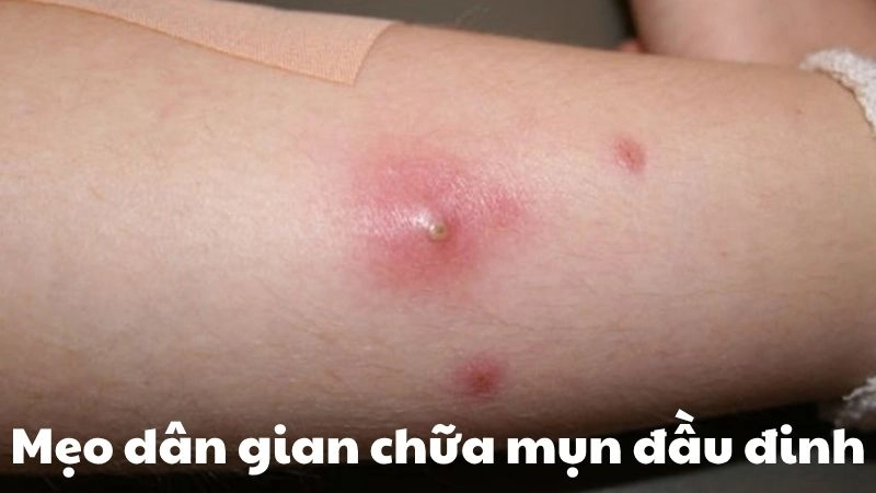 Khám phá ngay mẹo dân gian chữa mụn đầu đinh nhanh khỏi