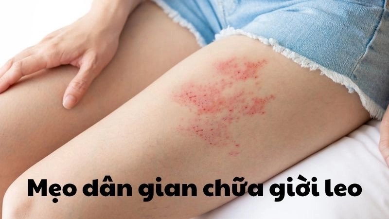 Mẹo dân gian chữa giời leo hiệu quả không phải ai cũng biết