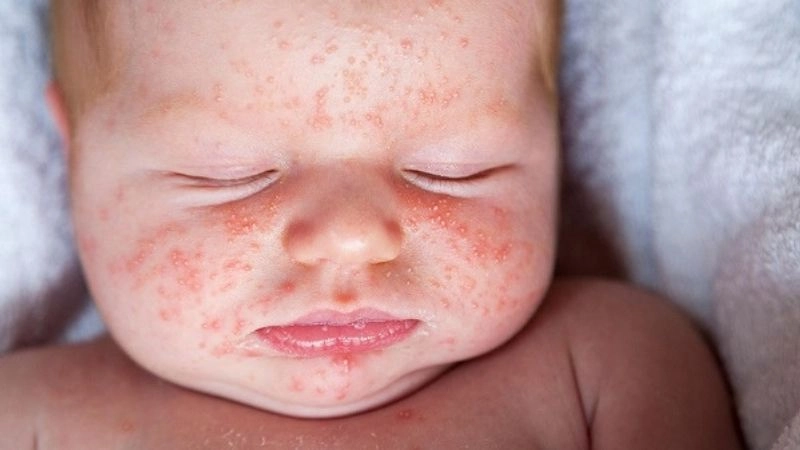 Nguyên nhân và triệu chứng của chàm sữa dễ nhận biết