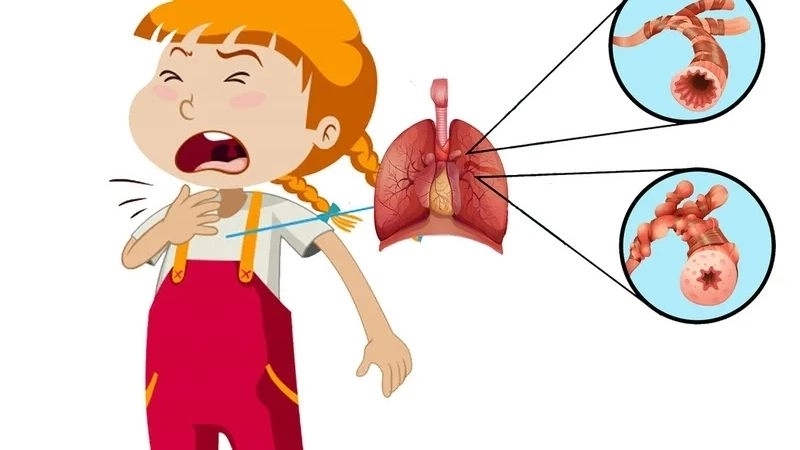 Hiểu rõ nguyên nhân khiến trẻ bị viêm phổi