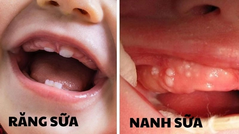 6. Phân biệt nanh sữa và mọc răng ở trẻ sơ sinh