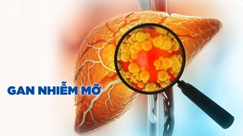 Nguyên nhân phổ biến gây gan nhiễm mỡ