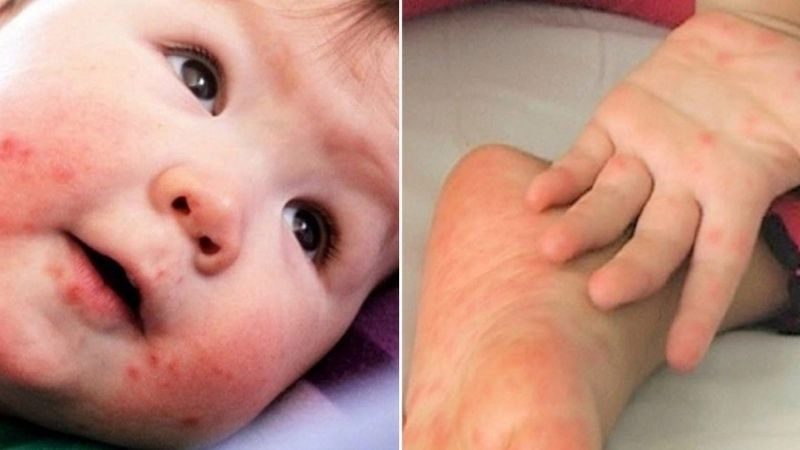 Nguyên nhân dẫn đến chân tay miệng mẹ không thể bỏ qua