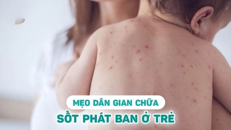 Mẹo dân gian chữa sốt phát ban tại nhà hiệu quả nhanh