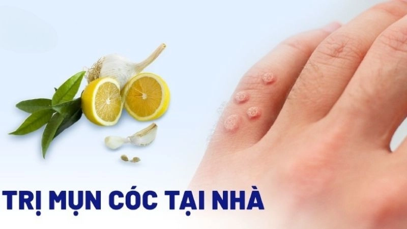 Hé lộ mẹo chữa mụn cóc dân gian bằng nguyên liệu dễ tìm