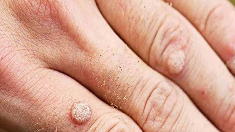9. Nguyên nhân gây nên mụn cóc ít ai ngờ