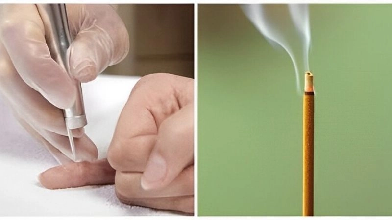 Mẹo chữa mụn cóc dân gian được tin dùng