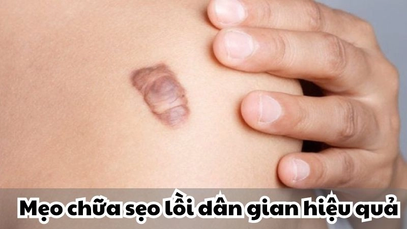 Mẹo chữa sẹo lồi dân gian hiệu quả bất ngờ từ thiên nhiên