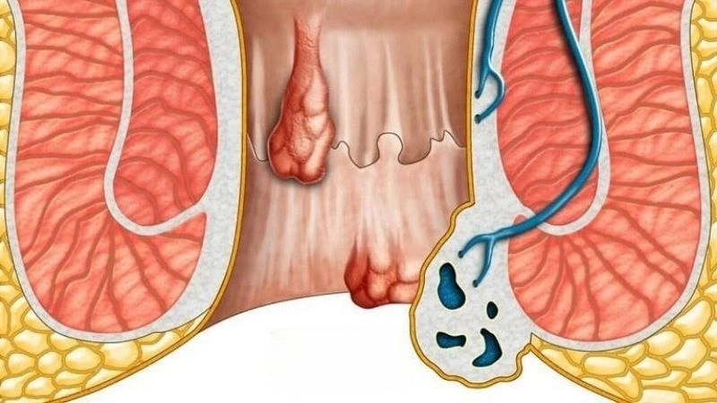 Nguyên nhân dẫn đến bệnh trĩ phổ biến hiện nay