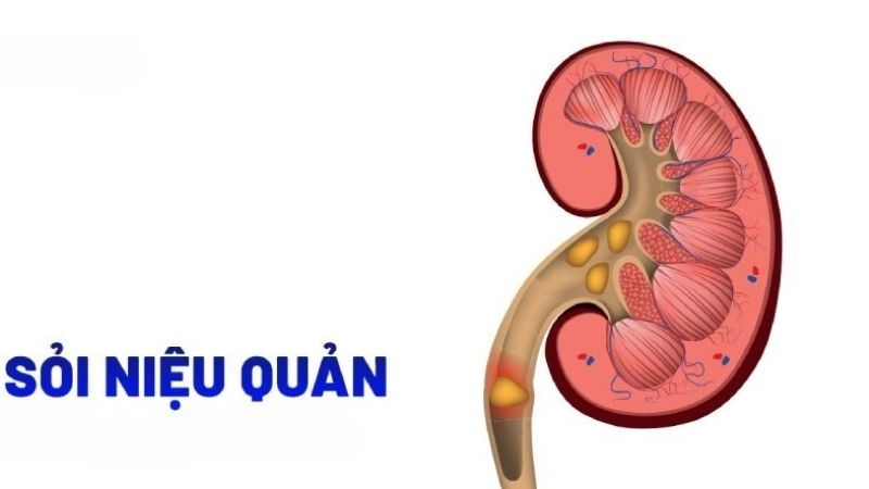 Sỏi niệu quản gây ra những triệu chứng