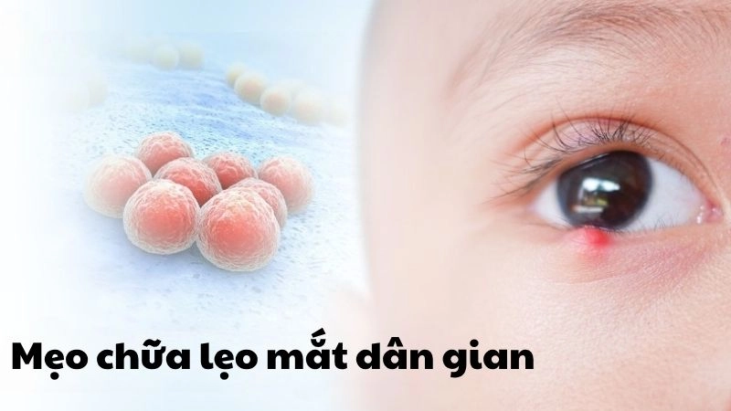 Bất ngờ với mẹo chữa lẹo mắt dân gian xưa hiệu quả bất ngờ
