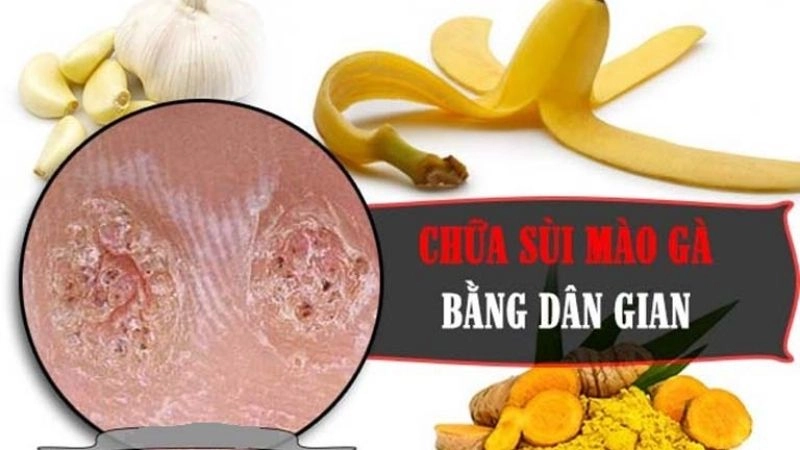 Tổng hợp mẹo dân gian chữa sùi mào gà từ xưa đến nay