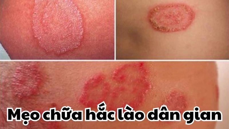 Mẹo chữa hắc lào dân gian đơn giản nhưng cực hiệu quả