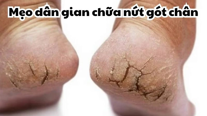 Hé lộ mẹo dân gian chữa nứt gót chân từ kinh nghiệm xưa