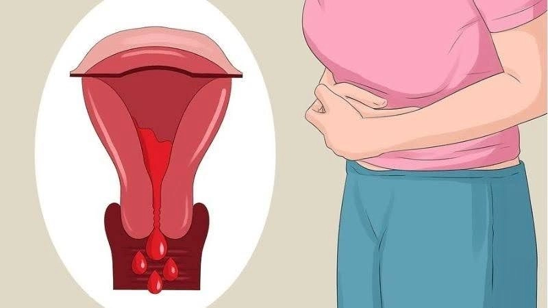 Nguyên nhân dẫn đến đau bụng kinh thường gặp