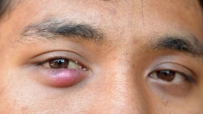 Nguyên nhân dẫn đến lẹo mắt phổ biến nhất