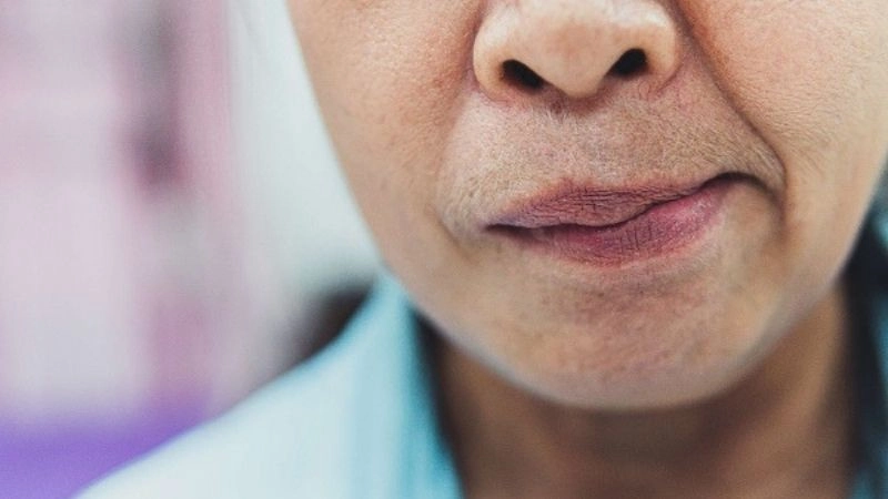 Nguyên nhân dẫn đến méo miệng thường gặp