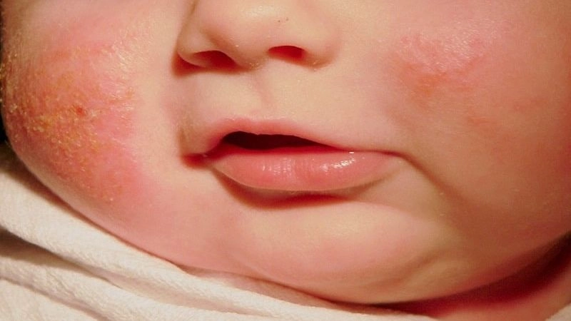 Nguyên nhân dẫn đến chàm sữa phổ biến