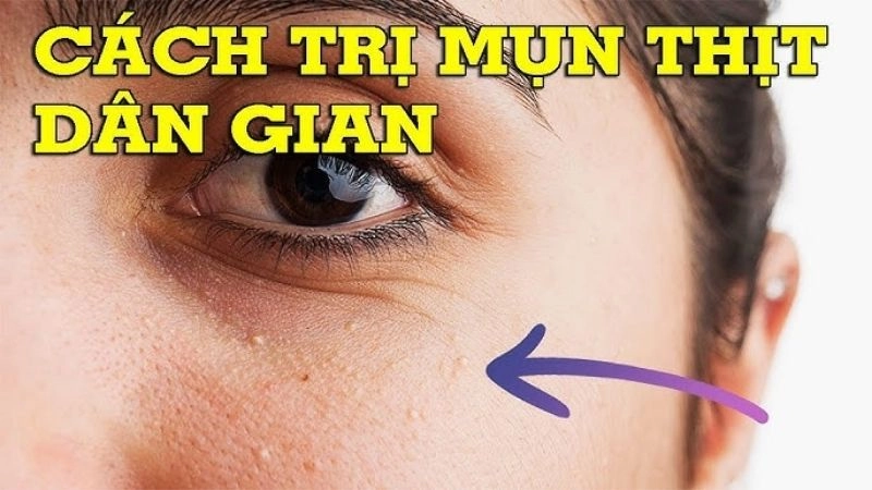 Bí kíp mẹo dân gian chữa mụn thịt hiệu quả không để lại sẹo