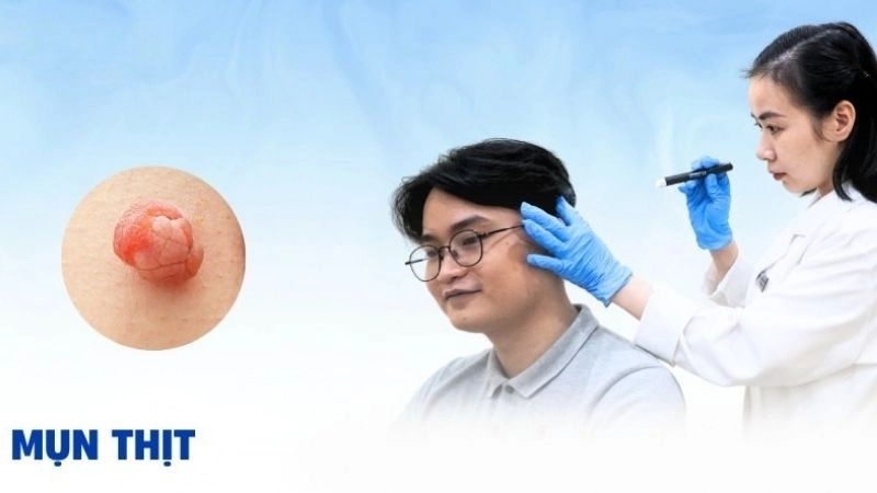 Nguyên nhân khiến mụn thịt xuất hiện 