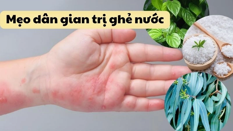 Cách dùng mẹo dân gian trị ghẻ nước không để lại sẹo