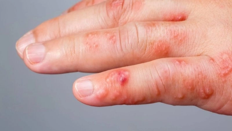 Nguyên nhân dẫn đến ghẻ nước thường gặp