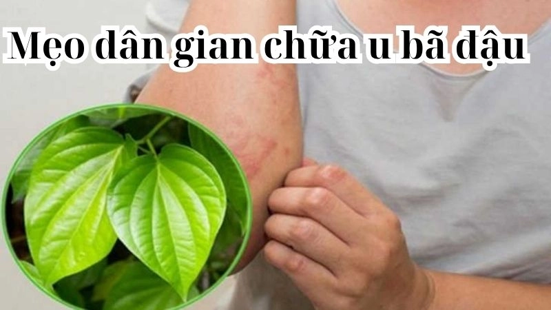 Mẹo dân gian chữa u bã đậu được lưu truyền nhiều đời