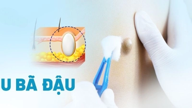 Nguyên nhân dẫn đến u bã đậu thường gặp