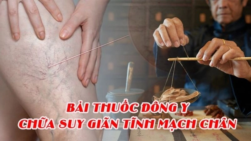 Hé lộ mẹo dân gian chữa giãn tĩnh mạch từ ngàn đời xưa