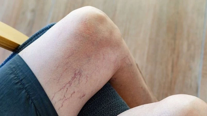 Nguyên nhân dẫn đến giãn tĩnh mạch ai cũng cần biết