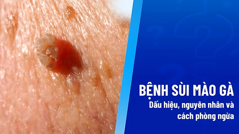 Sùi mào gà là gì? Bệnh lý lây truyền phổ biến bạn cần biết