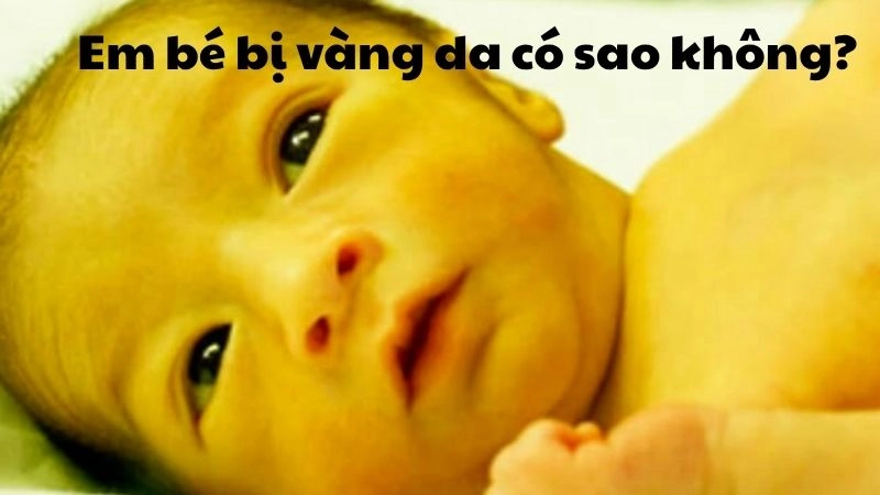 Em bé bị vàng da có sao không? Cha mẹ đừng chủ quan
