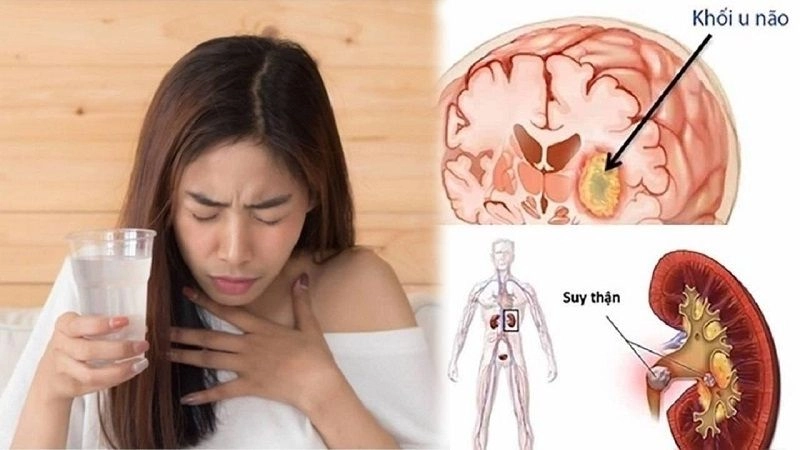  nấc cụt là hiện tượng bình thường, không nguy hiểm, chỉ gây khó chịu và bất tiện 