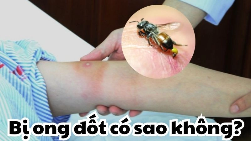 Bị ong đốt có sao không và cách xử lý an toàn tại nhà