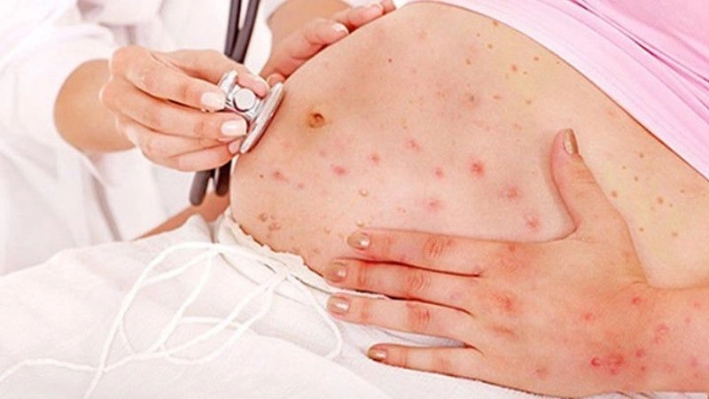 Nguyên nhân bà bầu bị zona thần kinh
