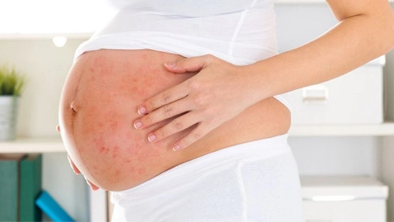 Bệnh zona thần kinh không chỉ gây ra những cơn đau nhức dữ dội mà còn ảnh hưởng nghiêm trọng đến sức khỏe và tinh thần của bà bầu