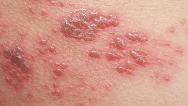 Triệu chứng khi bị zona và dấu hiệu ở mẹ bầu cần biết