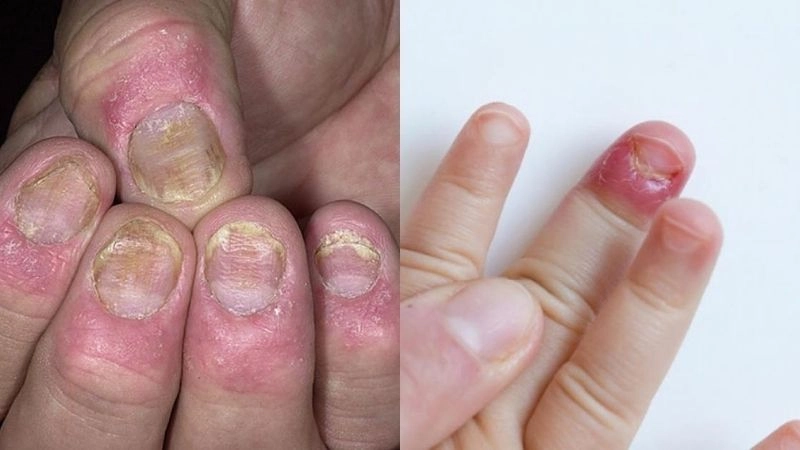 Nguyên nhân cắn móng tay và các yếu tố liên quan