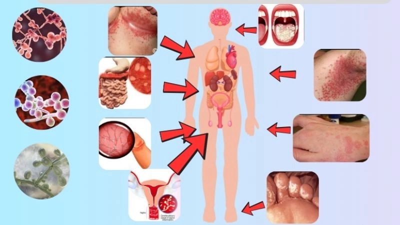Nấm Candida có tên gọi khoa học là Candida albicans, là một loại nấm men có hình tròn hoặc bầu dục, kích thước khoảng 2-5μm. Loại nấm này thường sống hoại sinh trên da và bên trong cơ thể như miệng, họng, ruột và âm đạo