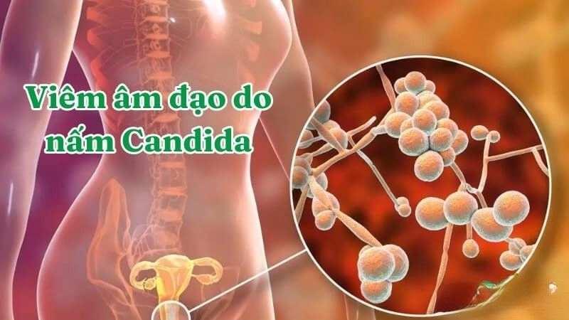 Nguyên nhân nhiễm nấm Candida ở âm đạo